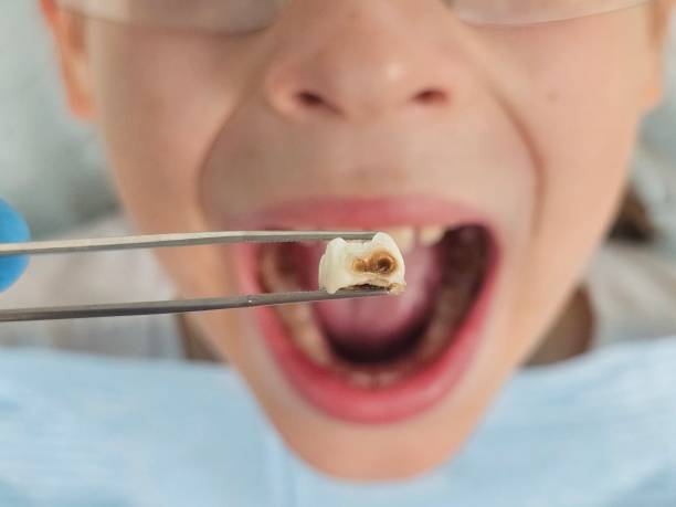 Best Emergency Treatment for Dental Infections or Abscesses in Huntington, UT